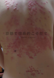 色素性痒疹の背部